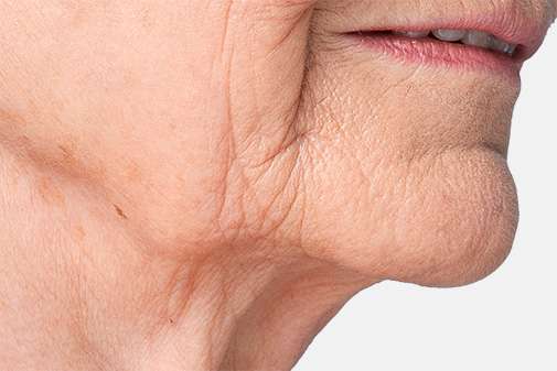 HIFU CollagenLift Sagging Jowls