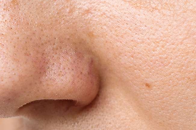 Exosome Elixir way enlarged pores