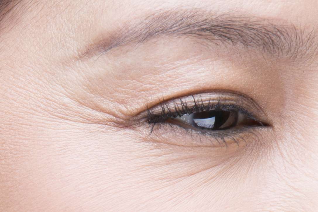 HIFU CollagenLift Crows feet