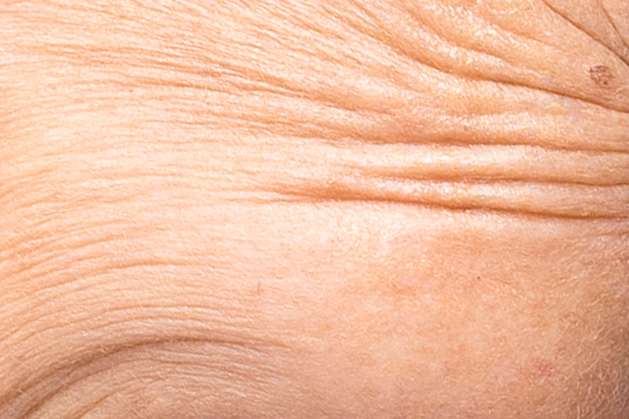 HIFU CollagenLift Fine Lines