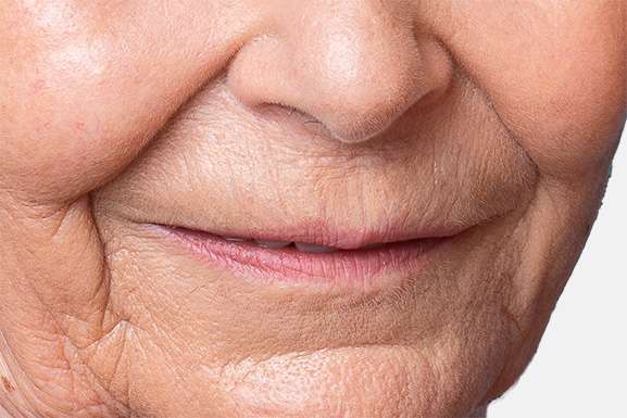 HIFU CollagenLift Nasolabial folds