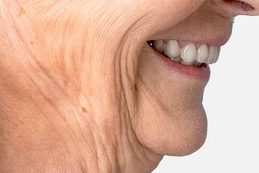 HIFU CollagenLift laugh lines