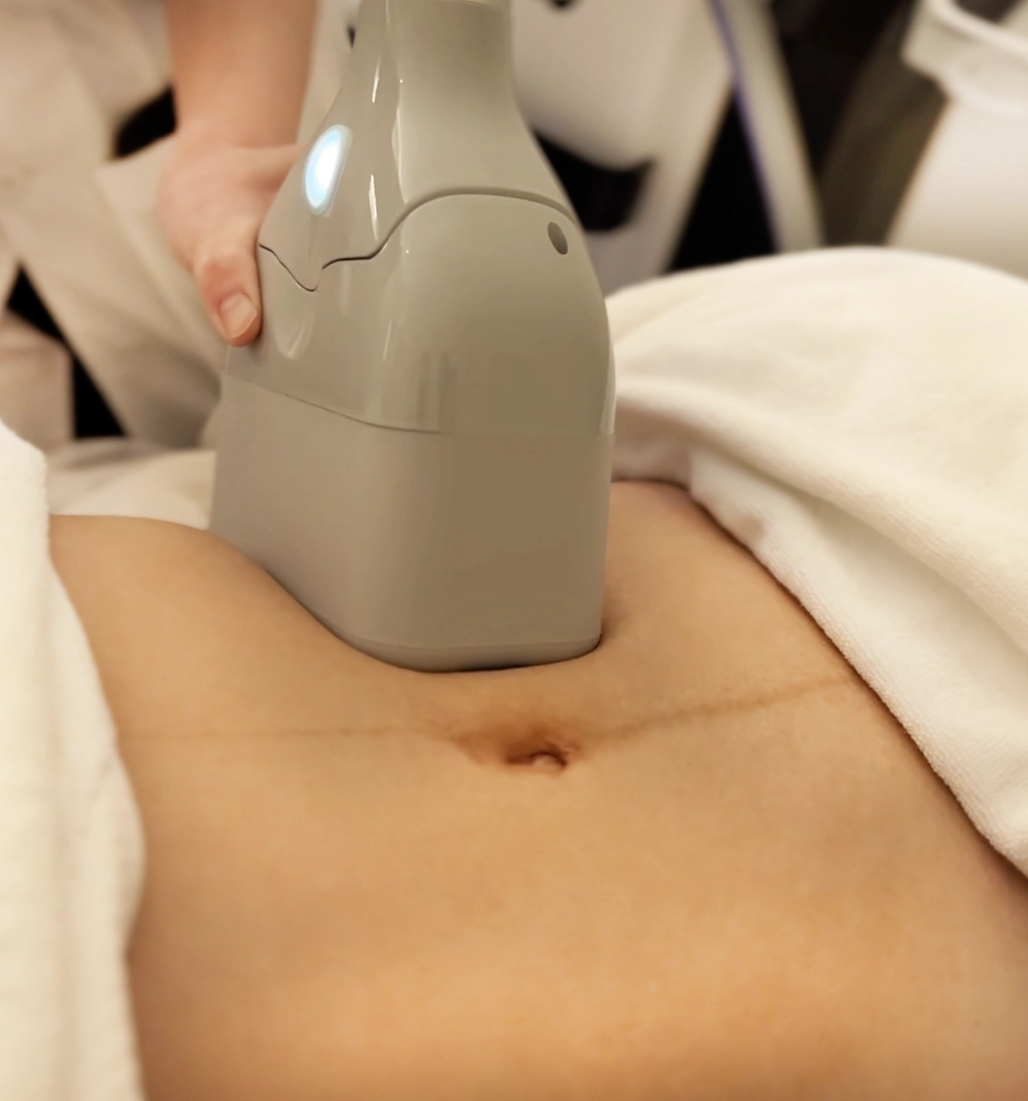 CryoTrim waist
