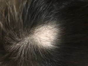hair loss alopecia