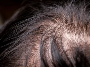 Thinning Hair