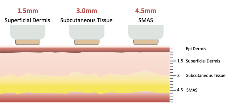 HIFU Treatment Depths