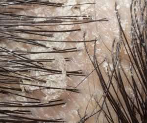 dry scalp